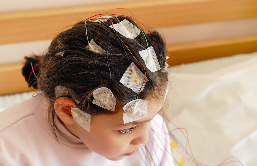 Absence seizures in children are diagnosed via several methods, including an EEG.